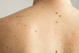 Image result for Urticaria pigmentosa children