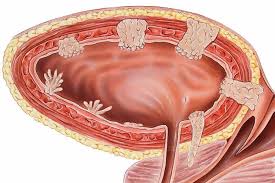 Image result for Bladder Cancer