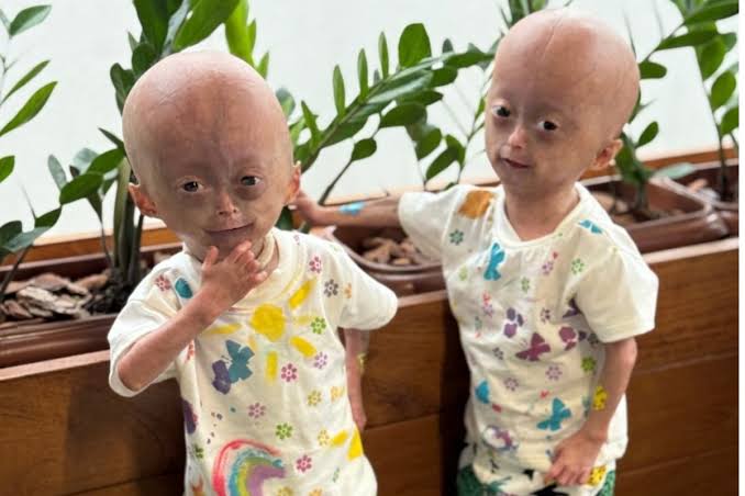 Morre Elis, gêmea diagnosticada com síndrome da velhice precoce