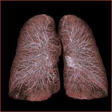 Lung cancer is a disease in which certain cells in the lungs become abnormal and multiply uncontrollably to form a tumor. Men Need More Frequent Lung Cancer Screening Than Women Imaging Technology News