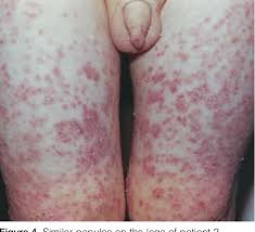 Image result for Papular Acrodermatitis