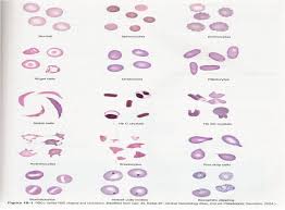 Rbc Morphology Google Search Hematology Medical
