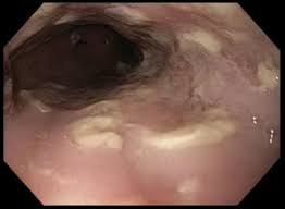 Although hsv esophagitis is much more common in immunosuppressed individuals, it can occur in healthy persons. Simultaneous Candida Albicans And Herpes Simplex Virus Type 2 Esophagitis In A Renal Transplant Recipient Bmj Case Reports