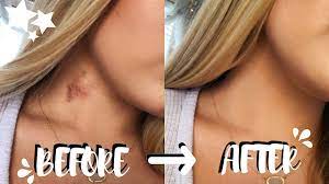 More images for how to cover a hickey without makeup » How To Get Rid Of Hickeys In Two Easy Steps No Color Correcting Brooklyn Anne Youtube