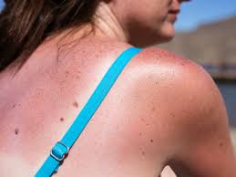 How do i know if i have sun poisoning. Signs You Could Have Sun Poisoning A Severe Type Of Sunburn