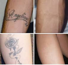 Looking for laser tattoo removal seattle and tattoo removal seattle? Tattoo Removal Worth It Wheaton Laser Tattoo Removal Tattoo Design
