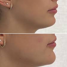 Michelle Deskin Beauty Nurse Injector