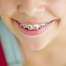 Metal Braces Orthodontics Types Of Braces Metal Braces