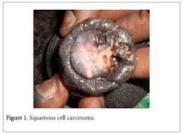 Résultat de recherche d'images pour "papilloma penis"