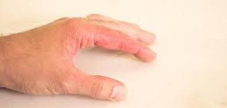 بلوط عظيم معهد المنع تنظيف جرح الحرق allusacars com