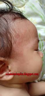 Terdapat 3 jenis demam denggi, iaitu demam denggi, demam denggi berdarah (dhf), dan sindrom kejutan denggi. Seindah Mimpiku Ingatkan Demam Denggi Rupanya Demam Campak Measles