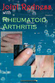 Joint Redness With Rheumatoid Arthritis Rheumatoid Arthritis Warrior Arthritis Treatment Rheumatoid Arthritis Rheumatoid Arthritis Treatment
