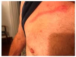 Image result for Trombicula autumnalis bites