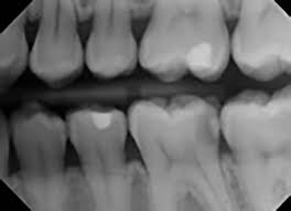 For example, capture images of the third. Dental X Rays University Of Michigan School Of Dentistry