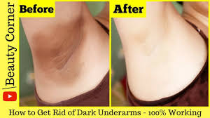 Feb 15, 2018 · if you want to try using a baking soda scrub: Lighten Dark Underarms Permanently Baking Soda Lemon Lightens Dark Underarms In Just 3 Days Youtube