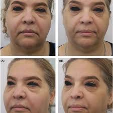 The picture shows the local spreading of the allergic reaction