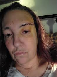 Recovery timeline after craniotomy surgery for AVM in brain?