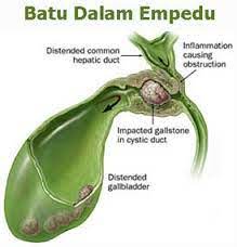 Kandung empedu mempunyai batas yang tegas. Suara Pipa