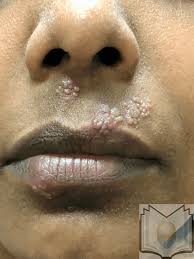 Herpes simplex virus infections may be caused by two virus genotypes: Herpes Simplex Type 1 Article