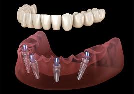 Safedent - All-On-Four Dental Implant