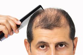 The american hair loss association states, while testosterone is at the core of the balding process, dht is thought to be the main culprit. it's now believed that dht contributes to androgenetic alopecia (male or female pattern baldness) by binding to receptors in the oil glands of scalp follicles, causing them to shrink. Understanding The Relationship Between Hair Loss Testosterone Ds Healthcare Group
