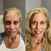 TOP 10 BEST Botox in Alpharetta, GA