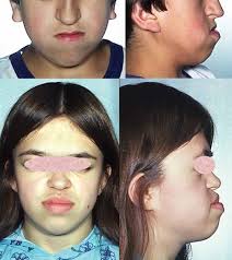 Axenfeld-Rieger syndrome: MedlinePlus Genetics