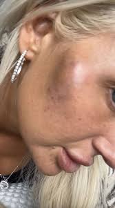 I was so addicted to filler that my 30th birthday 'glow up' left me  deformed