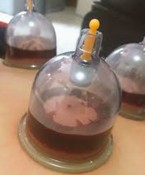 Mark Gil G. Soverano on Twitter: "My 1st Hijama (Wet cupping ...