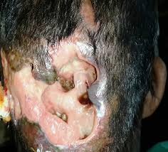 Myasis atau belatungan adalah infestasi larva lalat ke dalam suatu jaringan hidup. Myiasis In Children Fly Larval Infestation Pediatric Oncall Journal