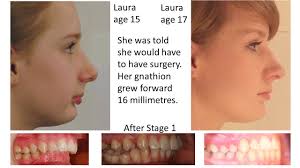 Orthodontist insisted that in order to get braces i would need 2 bottom pre  molars at the start and possibly 2 more at top later