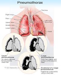What Does A Collapsed Lung Feel Like Symptoms Causes Recovery