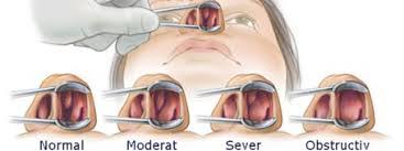 Cand bebe are nasul infundat inseamna de cele mai multe ori raceala sau gripa, iar mamicile aud sunetul specific acestei afectiuni si se sperie pentru ca stiu ce urmeaza: Rinita Cronica Hipertrofica Alerta Orl