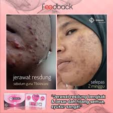 Gatal mata, hidung, telinga dan muka, kerap bersin, berkahak, banyak jerawat, kurang pendengaran/penglihatan, sakit kepala, kelemumur banyak, rambut gugur, nafas berbau (anda tidak tahu nafas anda berbau dan tidak menyenangkan rakan anda.minta nasihat. Tips Hilangkan Jerawat T9 Skincare