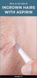 Ingrown hairs, commonly known as razor bumps, are hairs that have curled around and grown aspirin aspirin can help reduce redness and inflammation, the two most common symptoms of the. How To Get Rid Of Ingrown Hairs With Aspirin Get Rid Of Ingrown Hairs Ingrown Hair Ingrown Hair Treatment