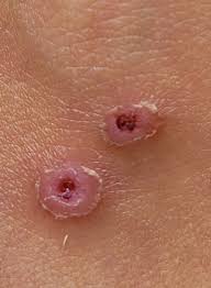 Image result for wolf spider bite skin