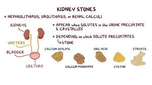 Image result for Calcium Nephrolithiasis