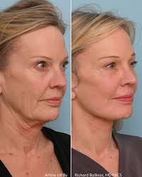 📸 Your Face, Your Body, Our Expertise! 🎨💪 👥 Witness the Perfect Fusion  of Expertise as Dr. Richard Balikian, the Master of Facial Rejuvenation,  joins forces with Dr. Tyler Frew the Architect