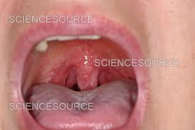 Image result for Tonsillitis