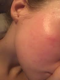 Sensitiv hud blir et stadig vanligere problem hos voksne. Rod Brennende Og Torr Hud I Ansiktet Kropp Og Helse Kvinneguiden Forum