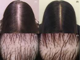 Jul 13, 2021 · microneedling with radiofrequency. Shedding Microneedling 3 Best Ways To Stop Minoxidil Shedding Hairguard Simply Put Microneedling Is The Insertion Microneedling Offers Fairly Immediate Results