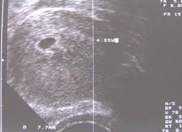 Check spelling or type a new query. Schwangerschaft 5 Woche 5 Ssw Ultraschallbilder