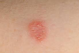 Is Ringworm Contagious American Kennel Club