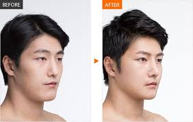 pin by absolute green inc on 整形手術 face contouring nose surgery cosmetic surgery