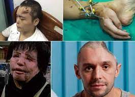 Nariz Na Testa Cranio Amassado E Oleo No Rosto Veja Os Casos Medicos Mais Chocantes De 2013 Fotos R7 Saude