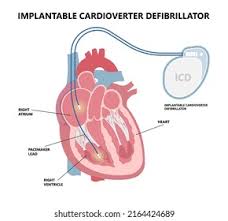 Image result for Internal Cardiac Defibrillator