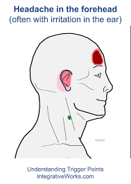 Headache In The Forehead Integrative Works Trigger Points Forehead Headache Headache