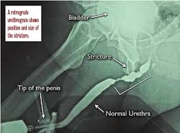 Image result for Retrograde Urethrogram