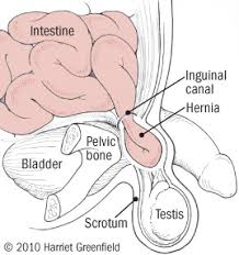 Hernias New Options For Management Harvard Health