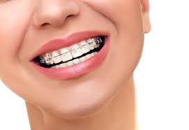 On the average, traditional metal braces will cost you almost $5,000 without insurance and $3000 if with insurance. Clear Braces